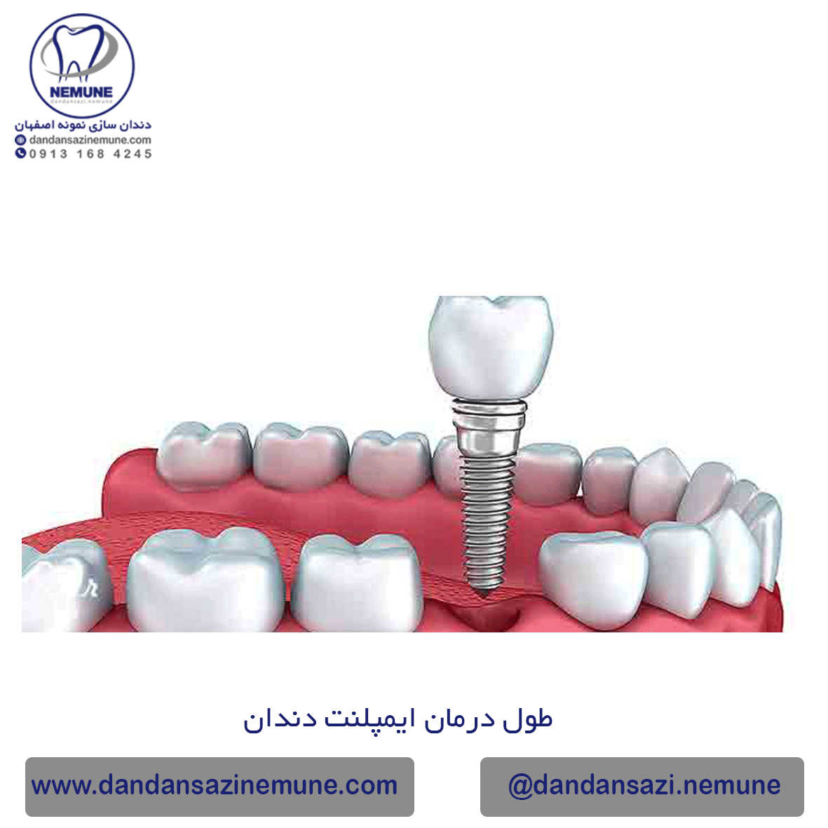 طول درمان ایمپلنت دندان