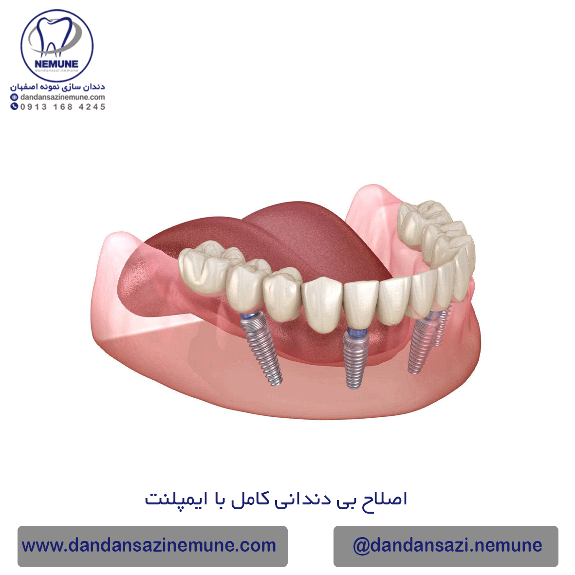 درمان بی دندانی قدامی با ایمپلنت